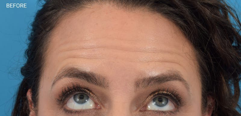 Botox Before & After Gallery - Patient 40563221 - Image 1