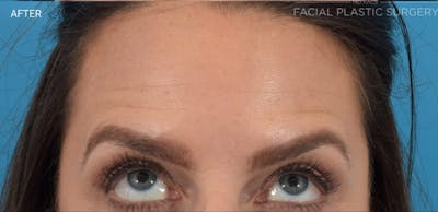 Botox Before & After Gallery - Patient 40563221 - Image 2