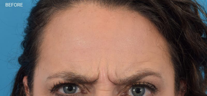 Botox Before & After Gallery - Patient 40563221 - Image 3