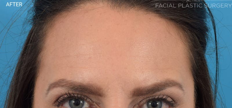Botox Before & After Gallery - Patient 40563221 - Image 4