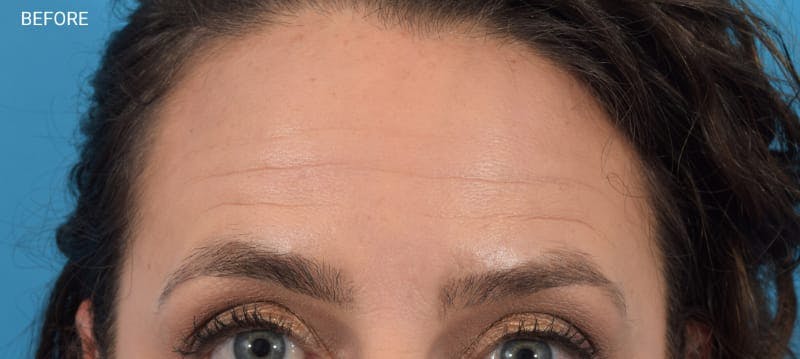 Botox Before & After Gallery - Patient 40563221 - Image 5