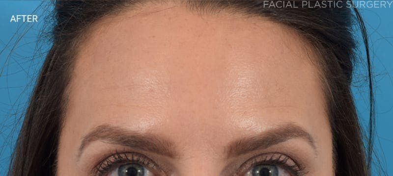 Botox Before & After Gallery - Patient 40563221 - Image 6
