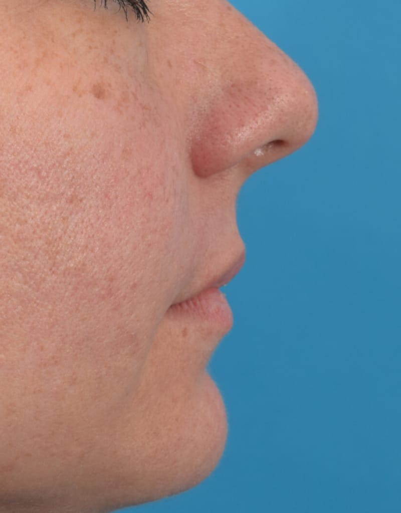 Filler - Lips Before & After Gallery - Patient 36543183 - Image 5