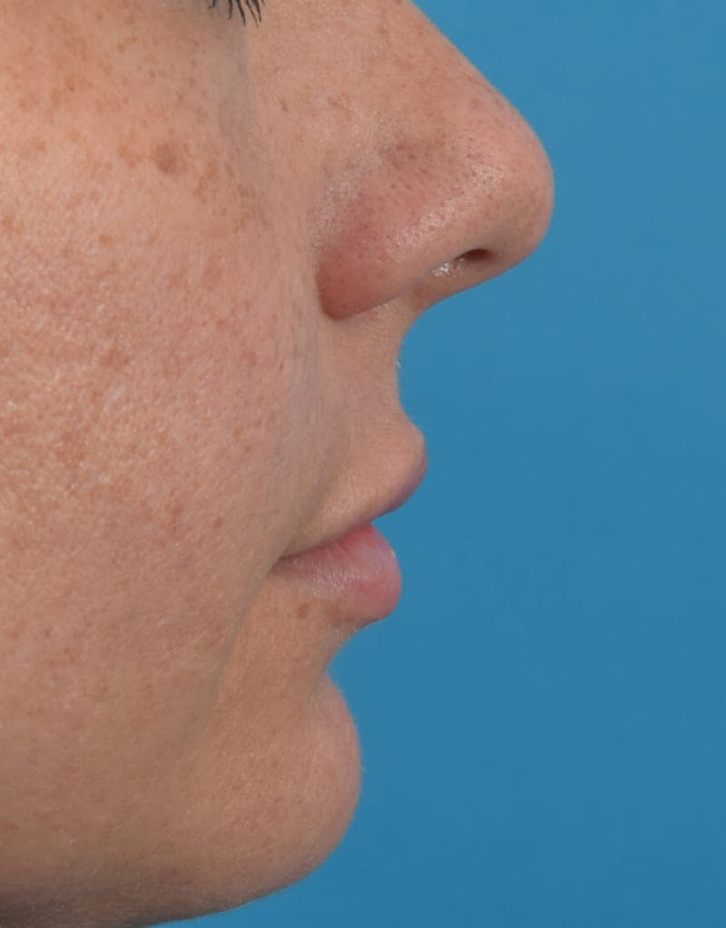 Filler - Lips Before & After Gallery - Patient 36543183 - Image 6