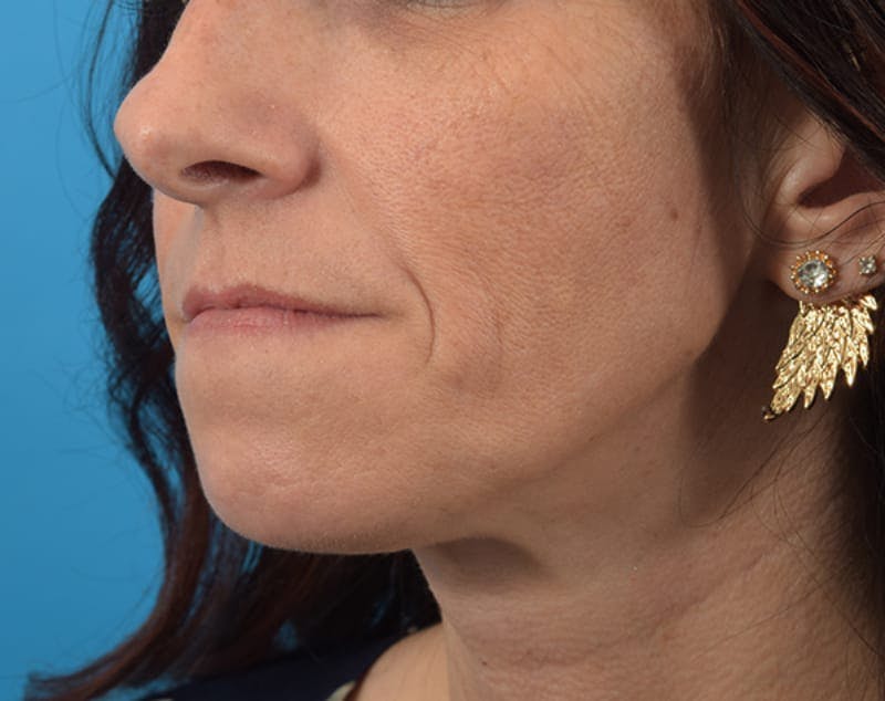 Filler - Lips Before & After Gallery - Patient 36543192 - Image 3