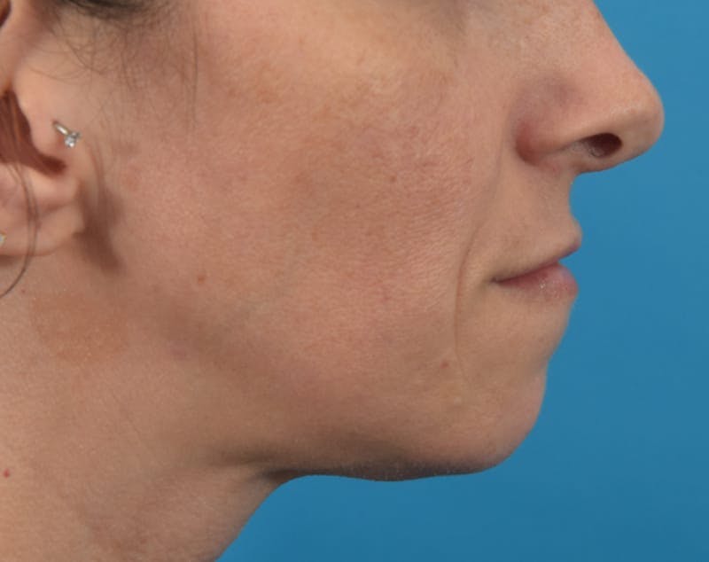 Filler - Lips Before & After Gallery - Patient 36543192 - Image 6