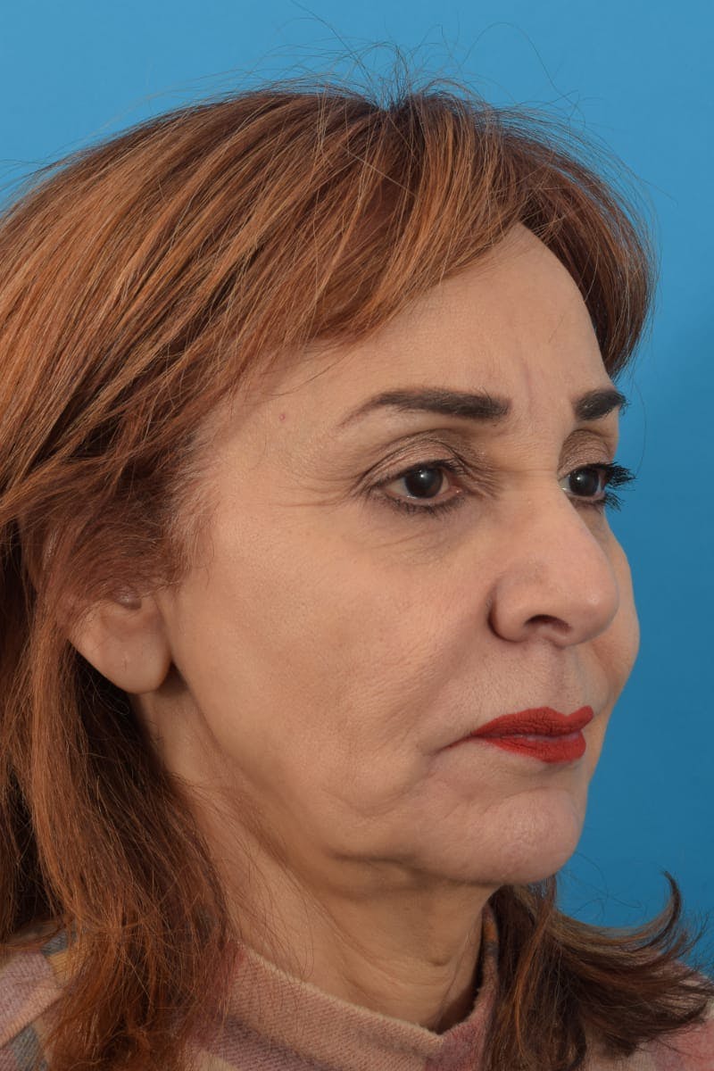 Filler - Lips Before & After Gallery - Patient 36543184 - Image 4