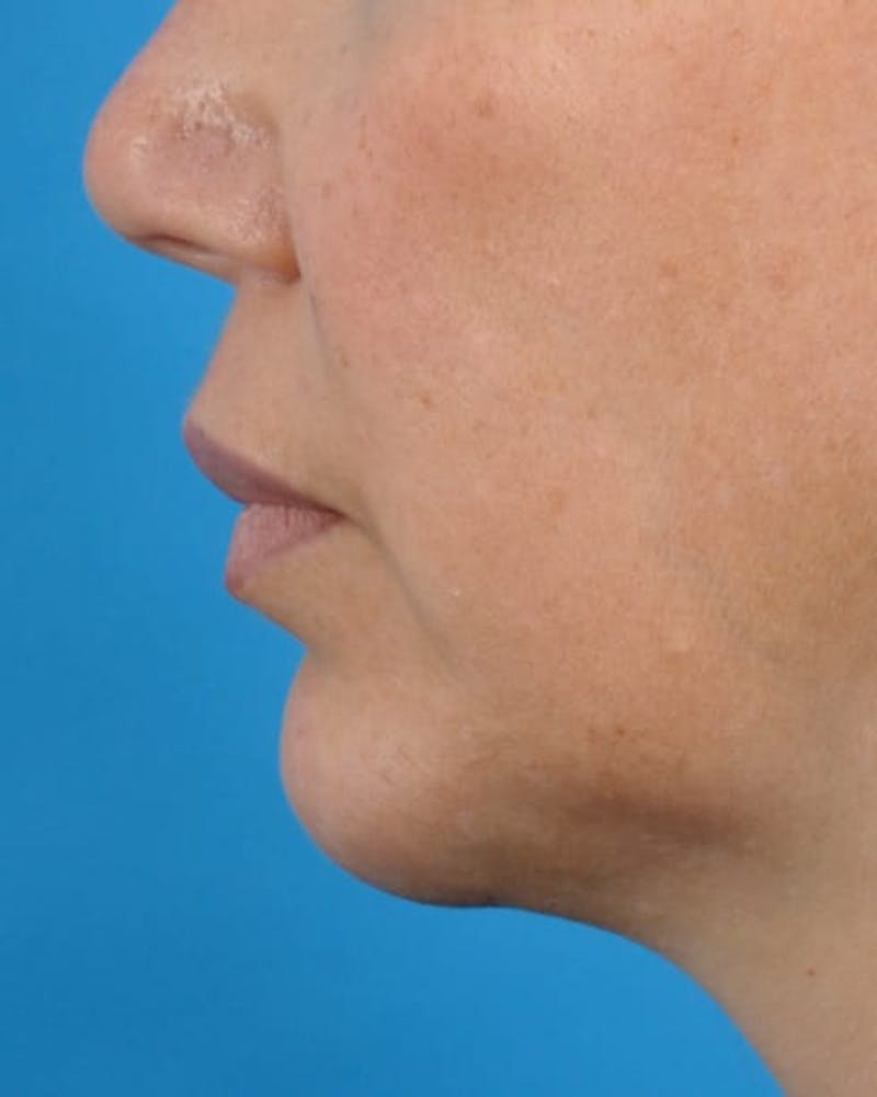 Filler - Lips Before & After Gallery - Patient 36543188 - Image 5