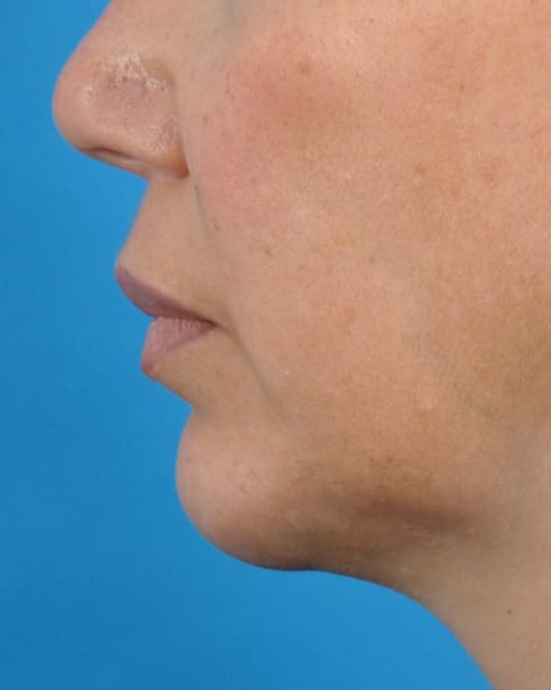 Filler - Lips Before & After Gallery - Patient 36543188 - Image 5