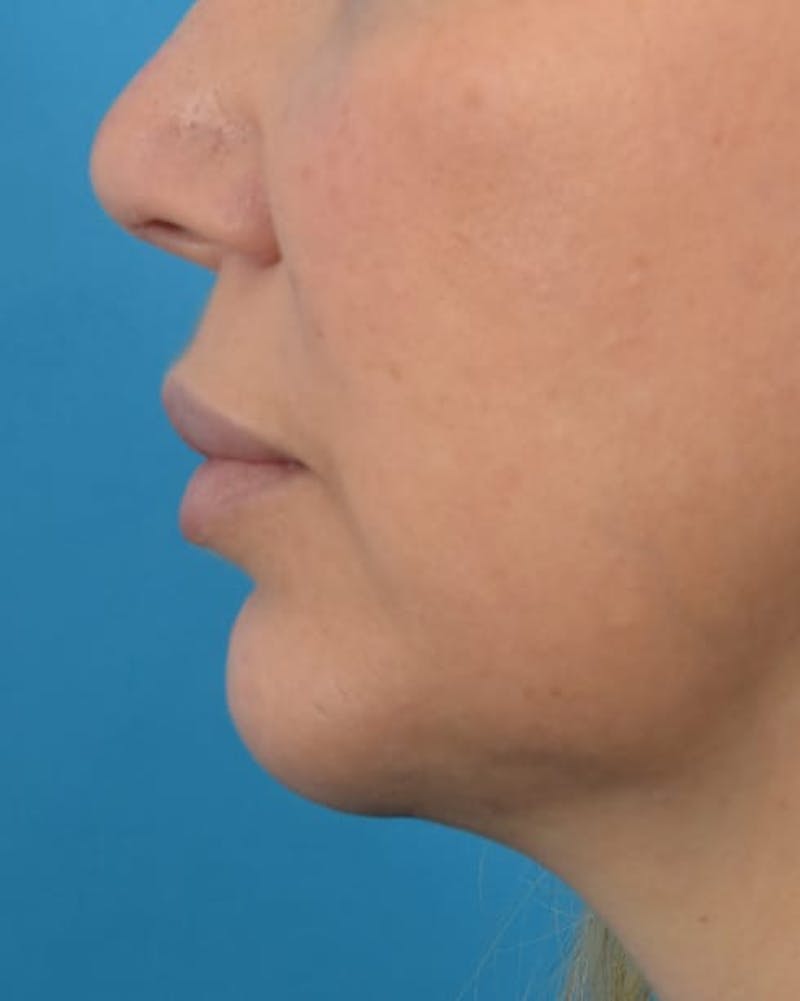 Filler - Lips Before & After Gallery - Patient 36543188 - Image 6