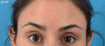 Neuromodulators (Botox, Dysport...) Before & After Gallery - Patient 40563338 - Image 2