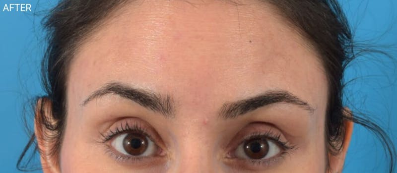 Neuromodulators (Botox, Dysport...) Before & After Gallery - Patient 40563338 - Image 2