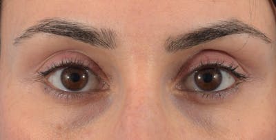 Filler-Tear Trough Before & After Gallery - Patient 40563368 - Image 1