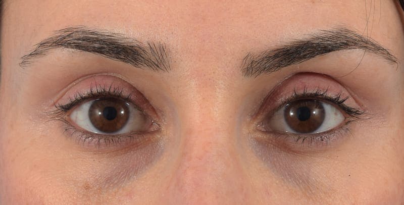 Filler-Tear Trough Before & After Gallery - Patient 40563368 - Image 1