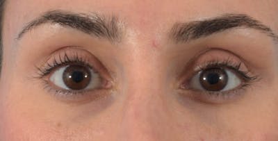 Filler-Tear Trough Before & After Gallery - Patient 40563368 - Image 2