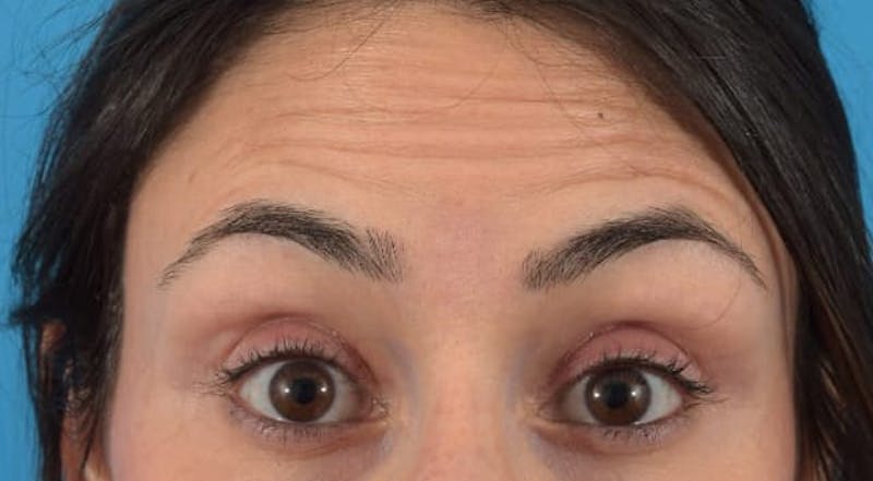 Botox Before & After Gallery - Patient 40563389 - Image 1
