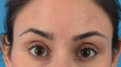 Botox Before & After Gallery - Patient 40563389 - Image 2
