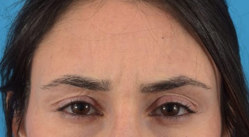 Botox Before & After Gallery - Patient 40563389 - Image 3