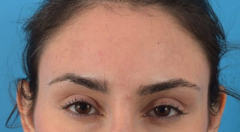 Botox Before & After Gallery - Patient 40563389 - Image 4