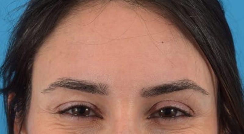 Botox Before & After Gallery - Patient 40563389 - Image 5
