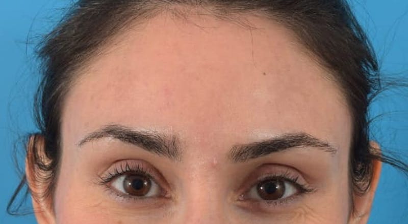 Botox Before & After Gallery - Patient 40563389 - Image 6
