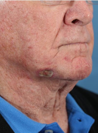 Skin Reconstruction Before & After Gallery - Patient 36550466 - Image 1