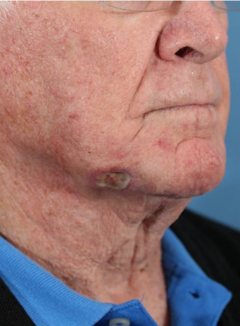 Skin Reconstruction Before & After Gallery - Patient 36550466 - Image 1