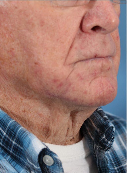 Skin Reconstruction