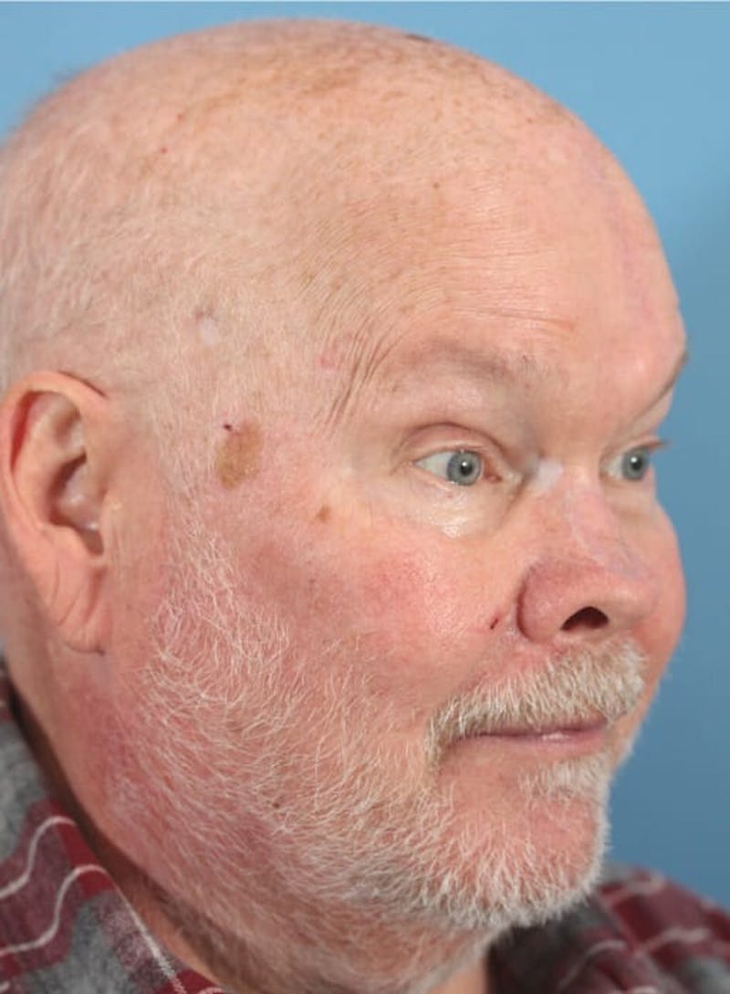 Skin Reconstruction Before & After Gallery - Patient 36550481 - Image 4