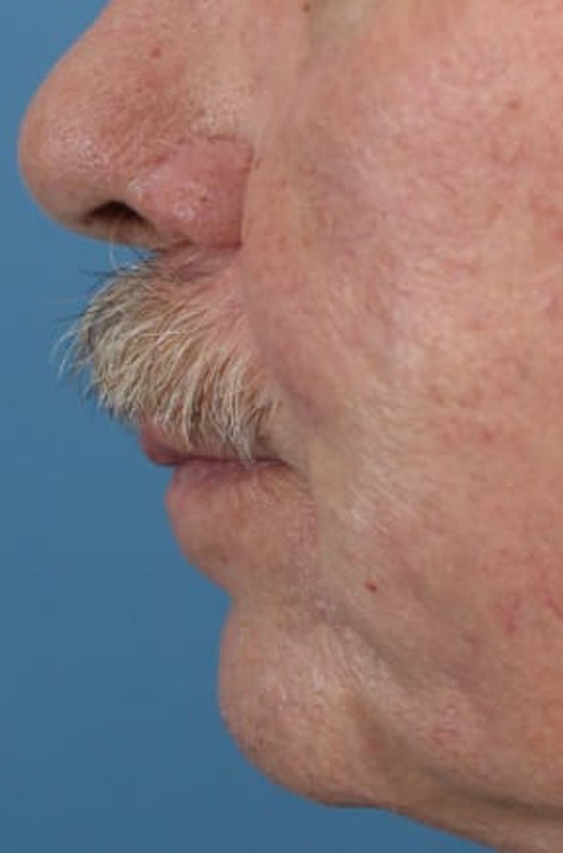 Skin Reconstruction Before & After Gallery - Patient 36550473 - Image 3