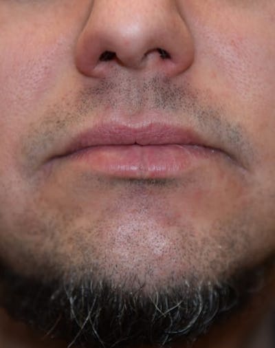 Skin Reconstruction Before & After Gallery - Patient 40563419 - Image 1