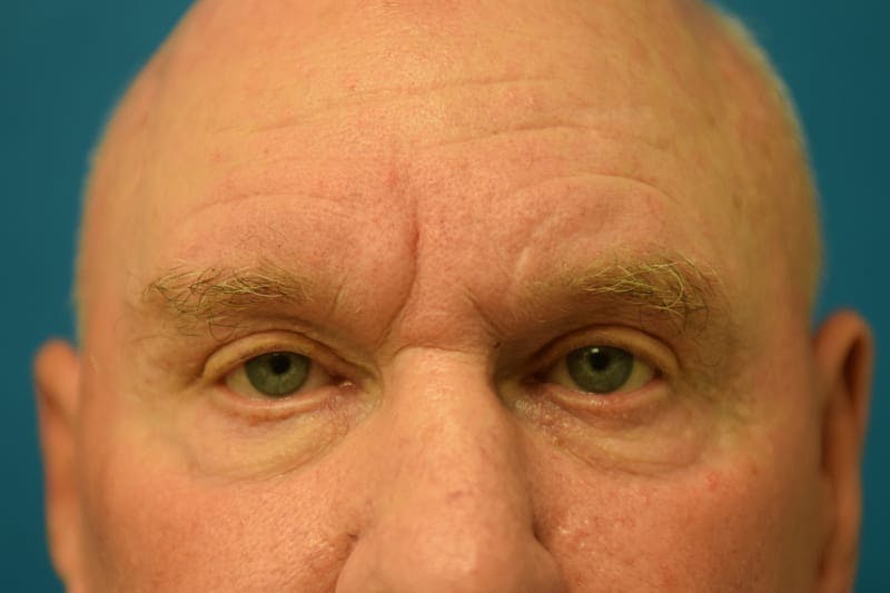 Blepharoplasty Before & After Gallery - Patient 36535140 - Image 1