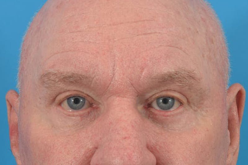 Blepharoplasty Before & After Gallery - Patient 36535140 - Image 2