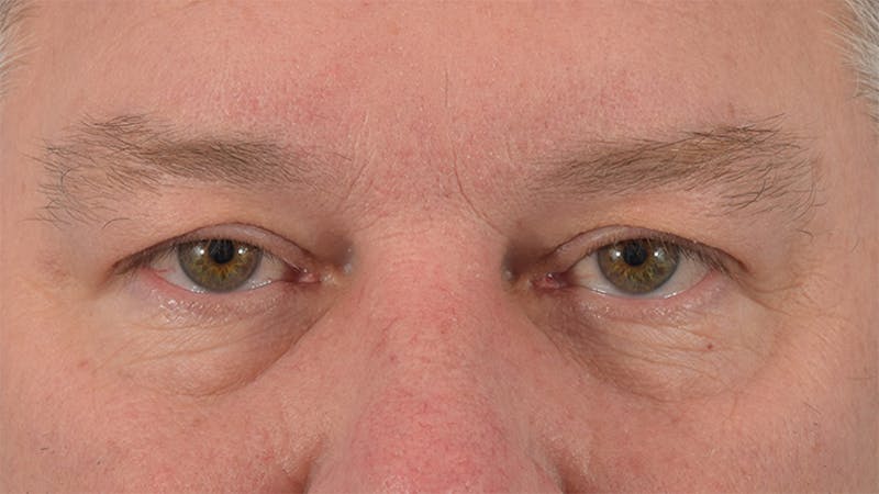 Blepharoplasty Before & After Gallery - Patient 57583630 - Image 1