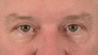 Blepharoplasty Before & After Gallery - Patient 57583630 - Image 2