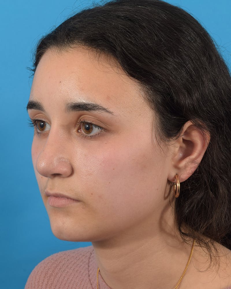 Rhinoplasty Before & After Gallery - Patient 48085211 - Image 4