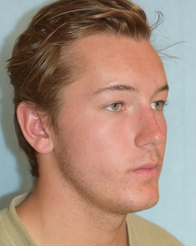 Rhinoplasty Before & After Gallery - Patient 48085213 - Image 1
