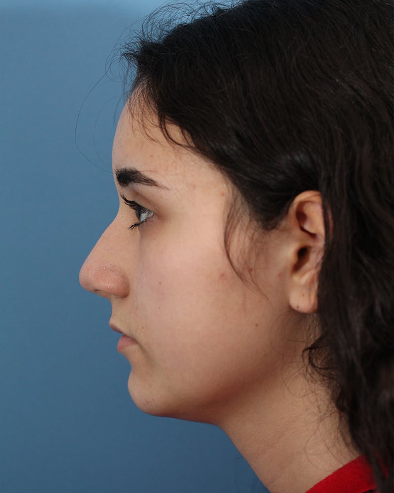 Rhinoplasty Before & After Gallery - Patient 48085211 - Image 1