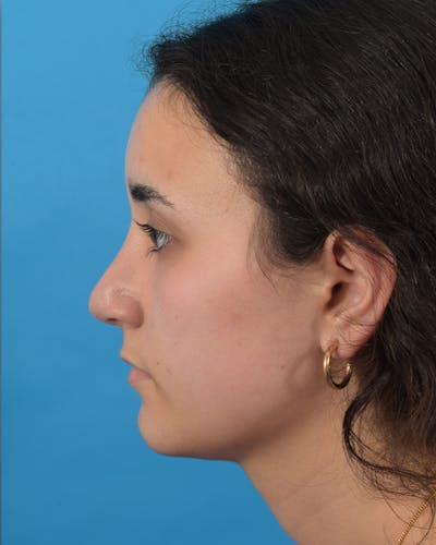 Rhinoplasty Before & After Gallery - Patient 48085211 - Image 2