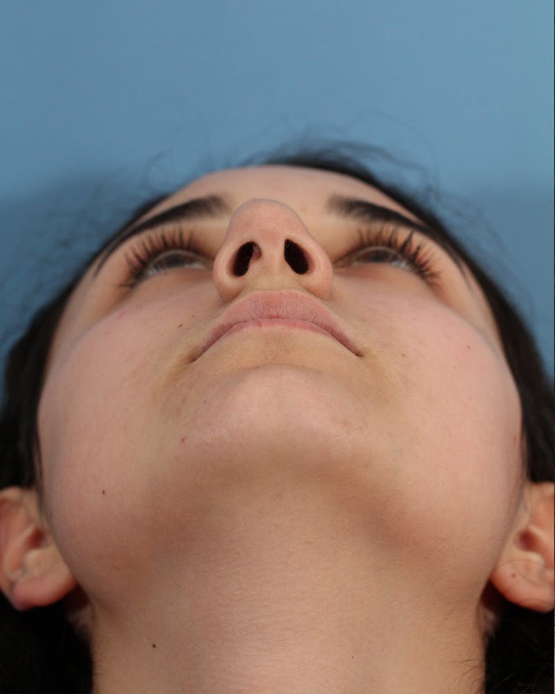 Rhinoplasty Before & After Gallery - Patient 48085211 - Image 7