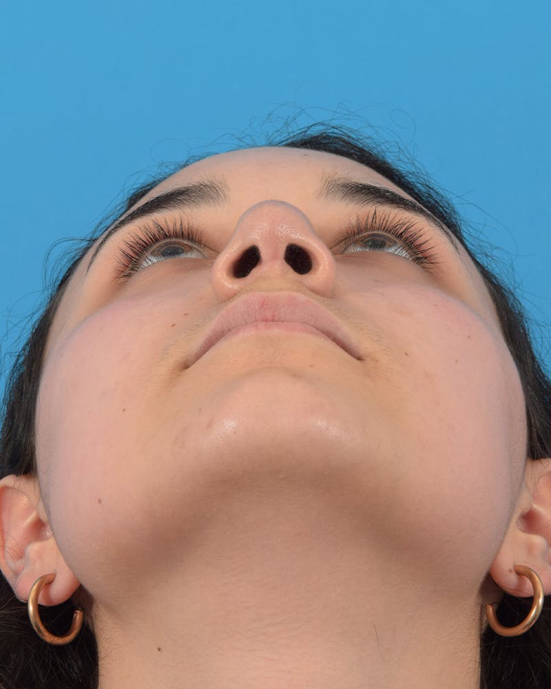 Rhinoplasty Before & After Gallery - Patient 48085211 - Image 8