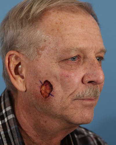 Skin Reconstruction Before & After Gallery - Patient 48085223 - Image 1