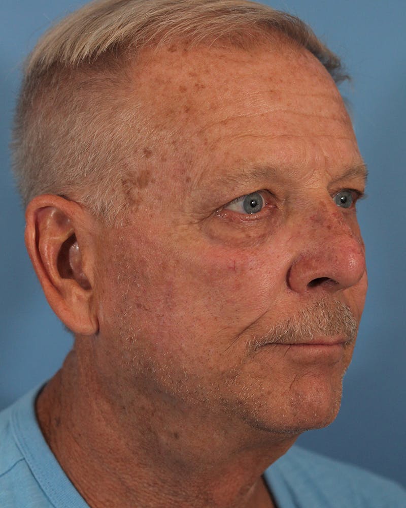 Skin Reconstruction Before & After Gallery - Patient 48085223 - Image 2