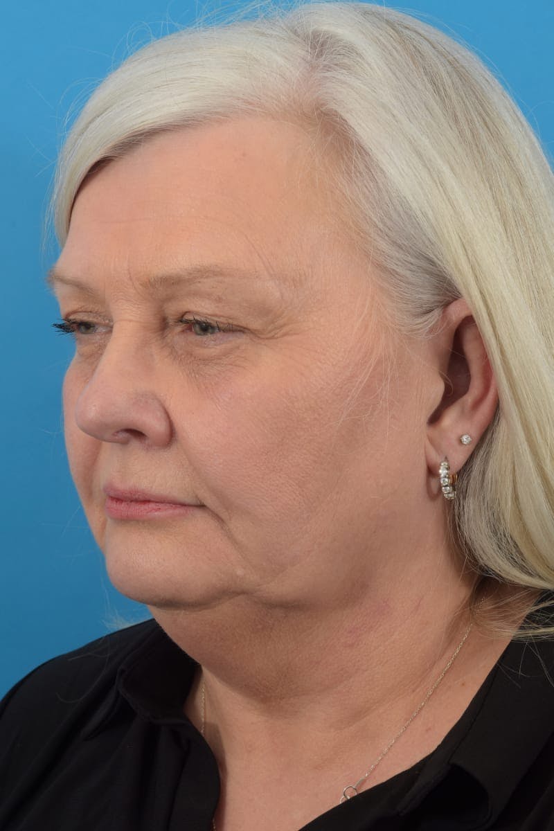 Facelift/Neck Lift Before & After Gallery - Patient 48085285 - Image 3