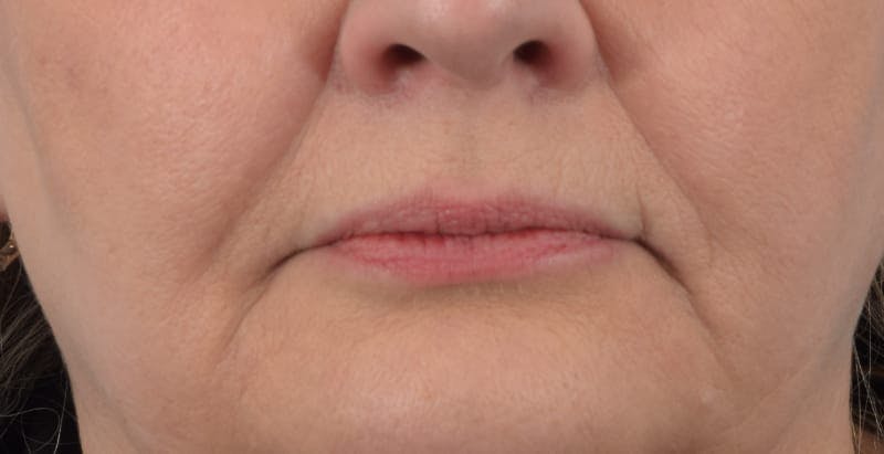Facelift/Neck Lift Before & After Gallery - Patient 48085285 - Image 7