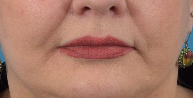 Facelift/Neck Lift Before & After Gallery - Patient 48085285 - Image 8