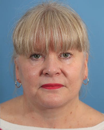 Facelift/Neck Lift Before & After Gallery - Patient 48085348 - Image 2
