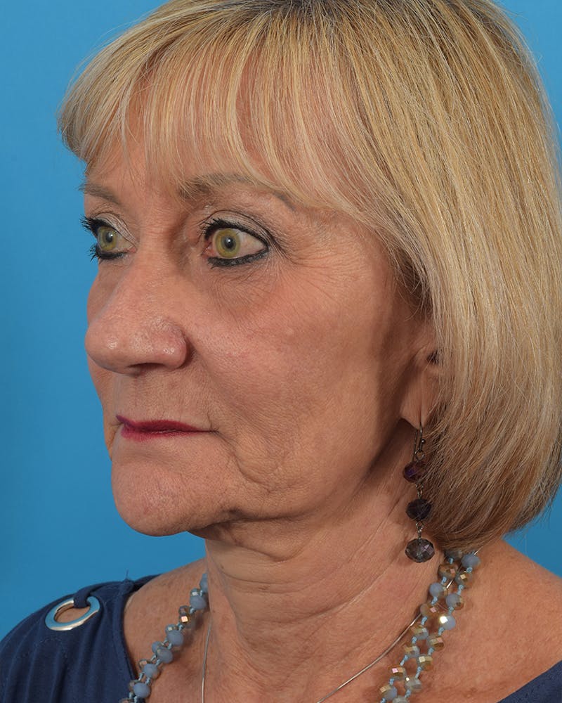 Facelift/Neck Lift Before & After Gallery - Patient 48085347 - Image 3