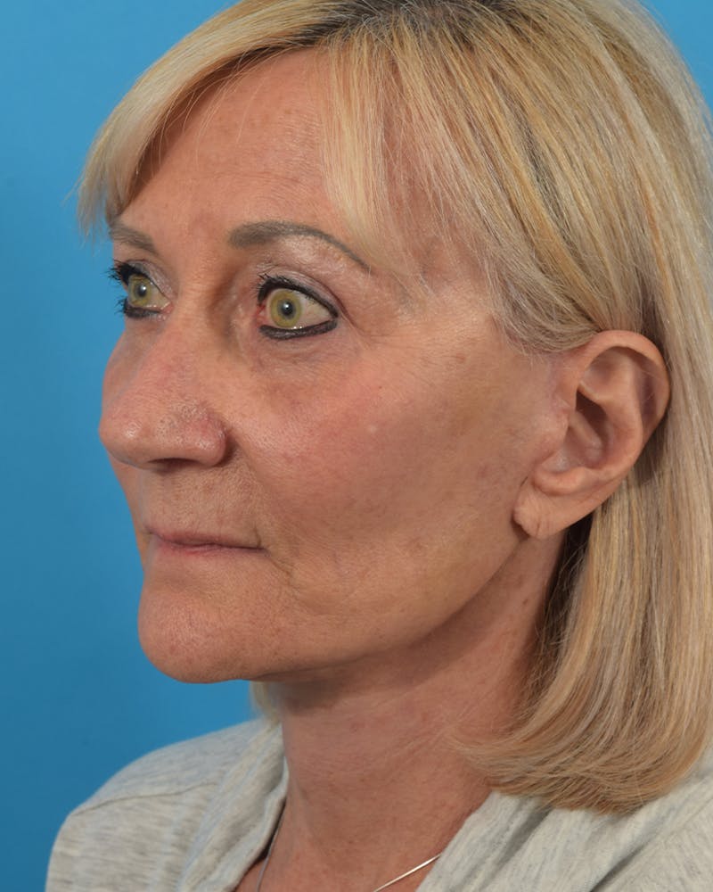 Facelift/Neck Lift Before & After Gallery - Patient 48085347 - Image 4