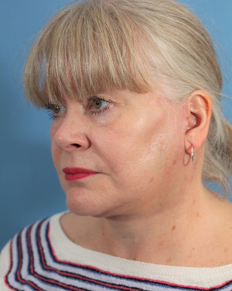 Facelift/Neck Lift Before & After Gallery - Patient 48085348 - Image 4